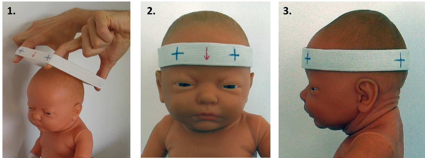 Почему голова вытянутая. Долихоцефалическая форма головы у новорождённых. Шлем для новорожденных для исправления формы головы. Правильная форма головы у грудничка. Асимметрия головы у новорожденного.