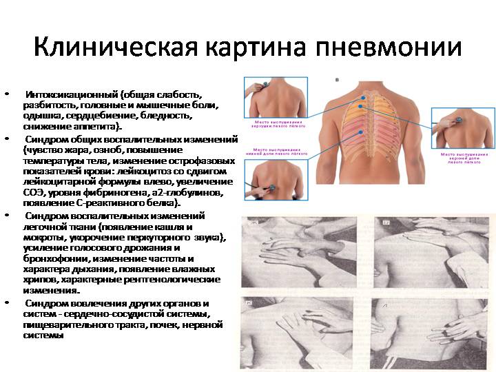 Боль в легком слева. Локализация боли при пневмонии. При пневмонии болит спина. Боль при воспалении легких.