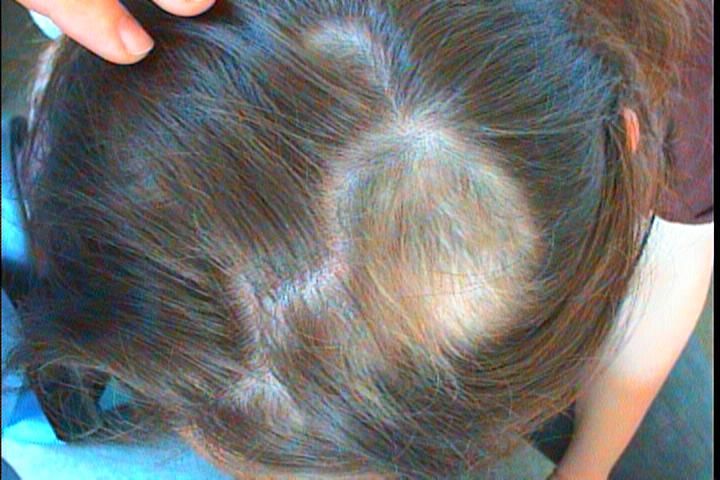После коронавируса выпадают волосы. Гнёздная алопеция у детей. Гнёздная очаговая алопеция у детей.