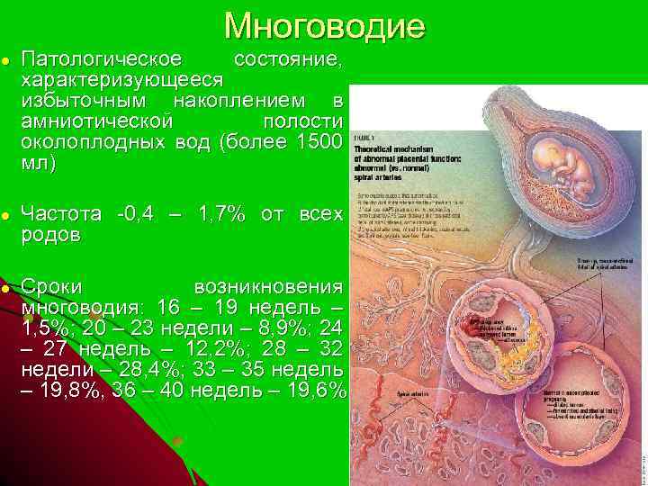 Маловодия при беременности 39 недель. Многоводие ИАЖ 30. Околоплодные воды многоводие. Многоводие показатели. Многообразная акушерская патология многоводие.