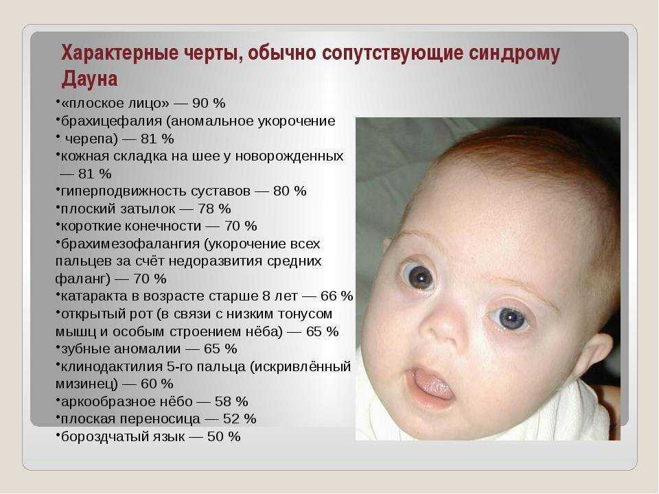 Синдром дауна ребенок живет. Симптомы синдрома Дауна у новорожденных. Признаки синдрома Дауна у новорожденного. Синдром Дауна признаки у новорожденных.