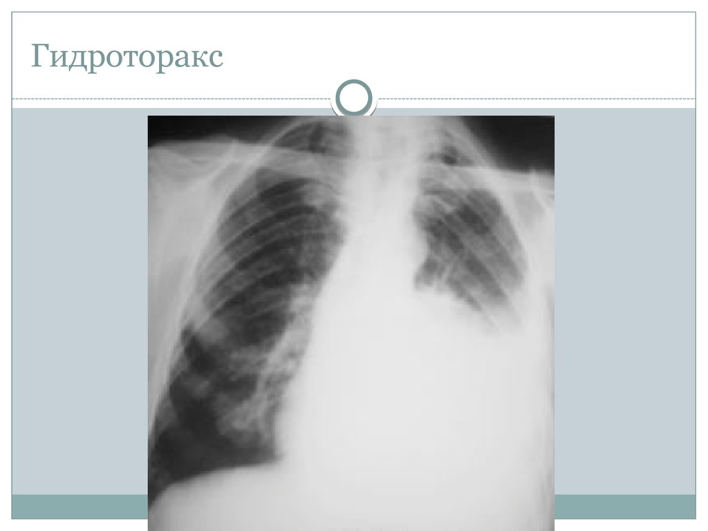 Признаки гидроторакса. Гидроторакс рентгенография. Рентген при гидротораксе. Плащевидный гидроторакс. Тотальный гидроторакс.