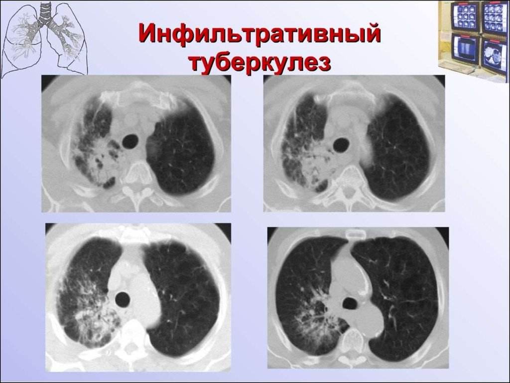 Очаговые изменения в легких на кт. Туберкулезная инфильтрация кт. Инфильтративный туберкулёз лёгких кт. Инфильтративный туберкулез томограмма. Инфильтративный туберкулез легких кт картина.