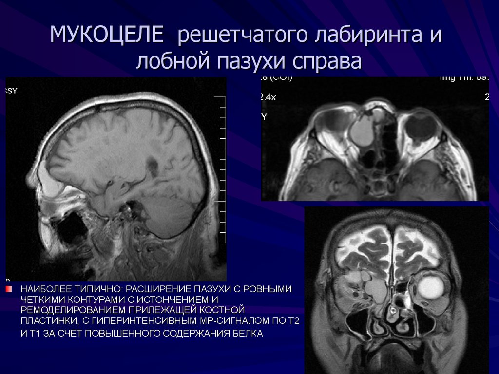 Мукоцеле носа. Мукоцеле основной пазухи на кт. Мукоцеле решетчатого Лабиринта кт. Мукоцеле клиновидной пазухи кт. Мукоцеле лобной пазухи рентген.