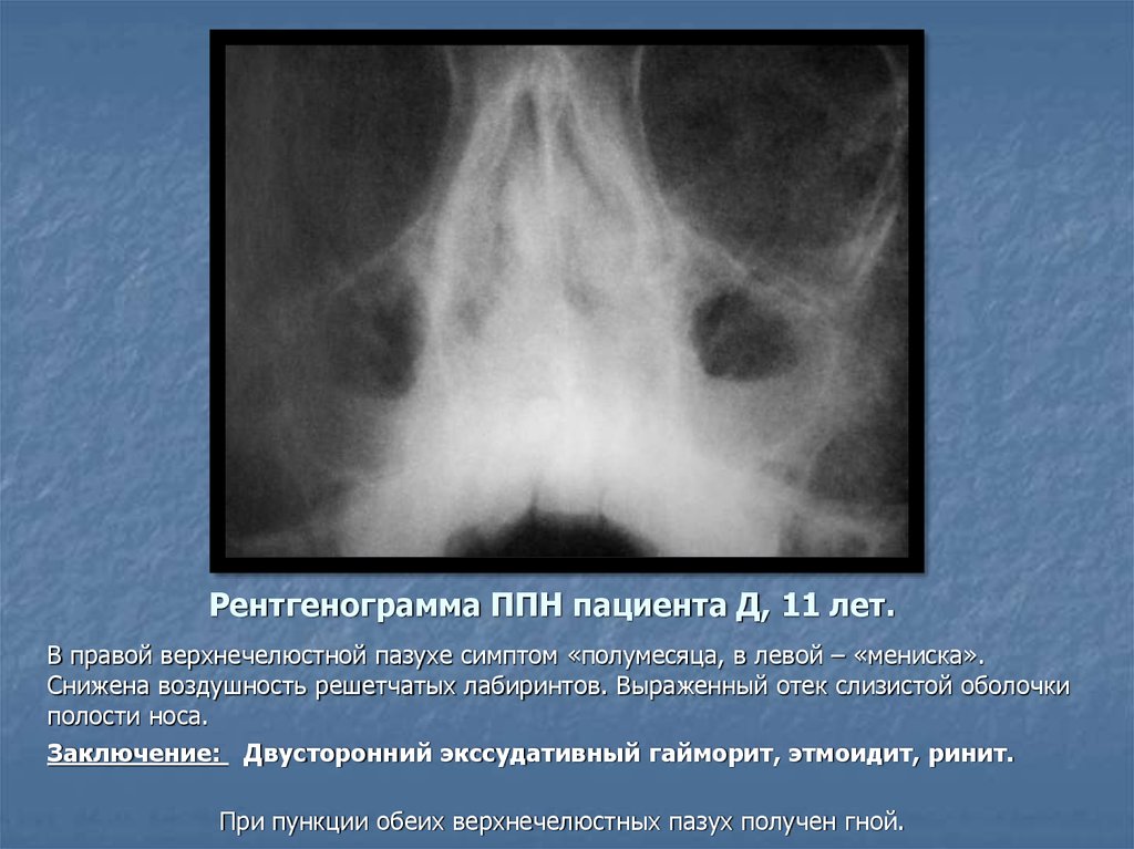 Рентгенологическая картина синусита