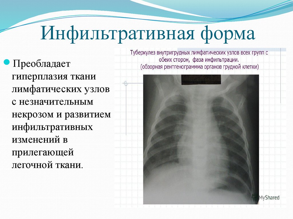 Инфильтративный туберкулез. Туберкулез внутригрудных лимфоузлов рентген. Малая форма туберкулеза внутригрудных лимфатических узлов рентген. ТВГЛУ инфильтративная форма. Клинико рентгенологические формы инфильтративного туберкулеза.