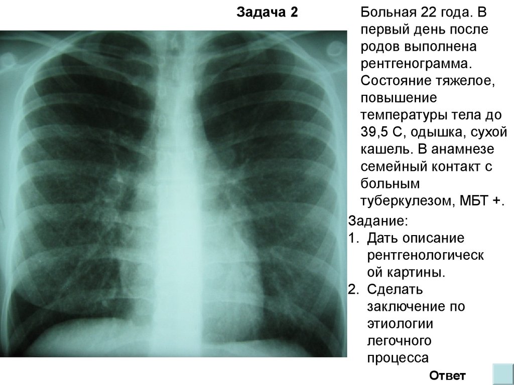 Туберкулез легкого рентгенограмма. Рентген грудной клетки туберкулез. Рентген больного туберкулезом. Туберкулёз лёгких рентген снимок. Туберкулез рентген снимки.