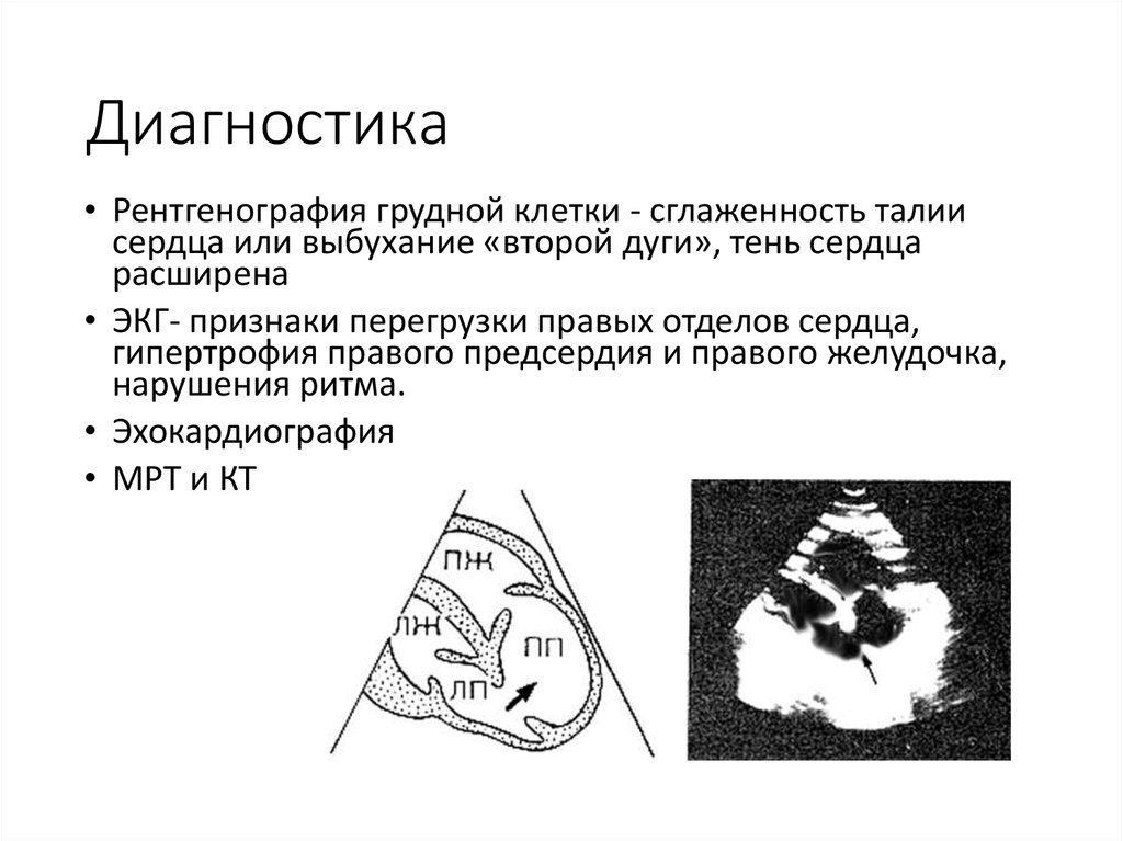 Дефект межпредсердной перегородки рекомендации. Дефект межпредсердной перегородки ЭХОКГ. Дефект межпредсердной перегородки ЭКГ. Первичный дефект межпредсердной перегородки. Гипертрофия межпредсердной перегородки.