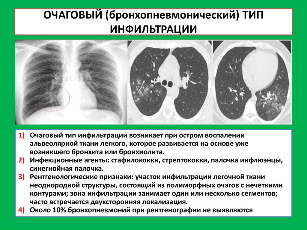 Легочный рисунок при пневмонии