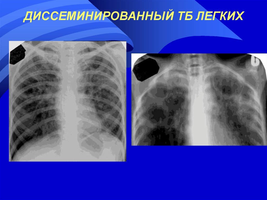 Диссеминированное поражение легких. Диссеминация туберкулеза на рентгене. Диссеминированный туберкулез рентген. Лимфогенно диссеминированный туберкулез рентген. Подострый диссеминированный туберкулез рентген.