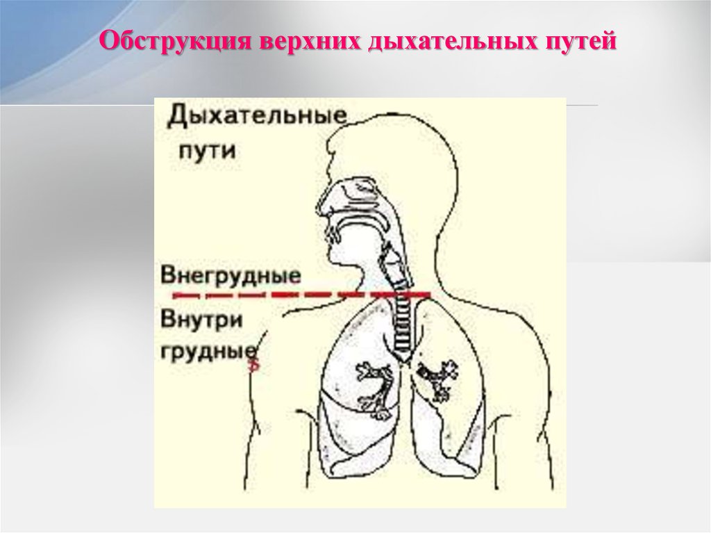 Виды обструкции дыхательных путей