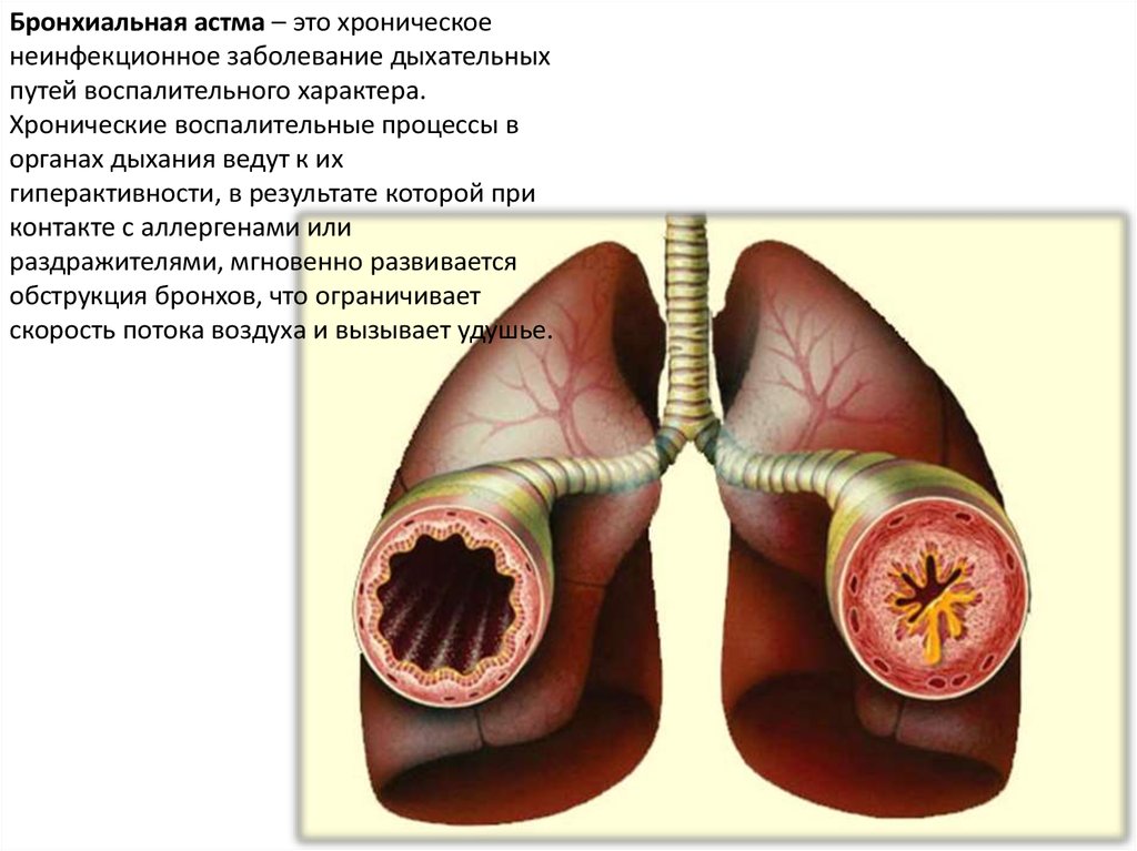 Бронхиальная астма картинки для буклета