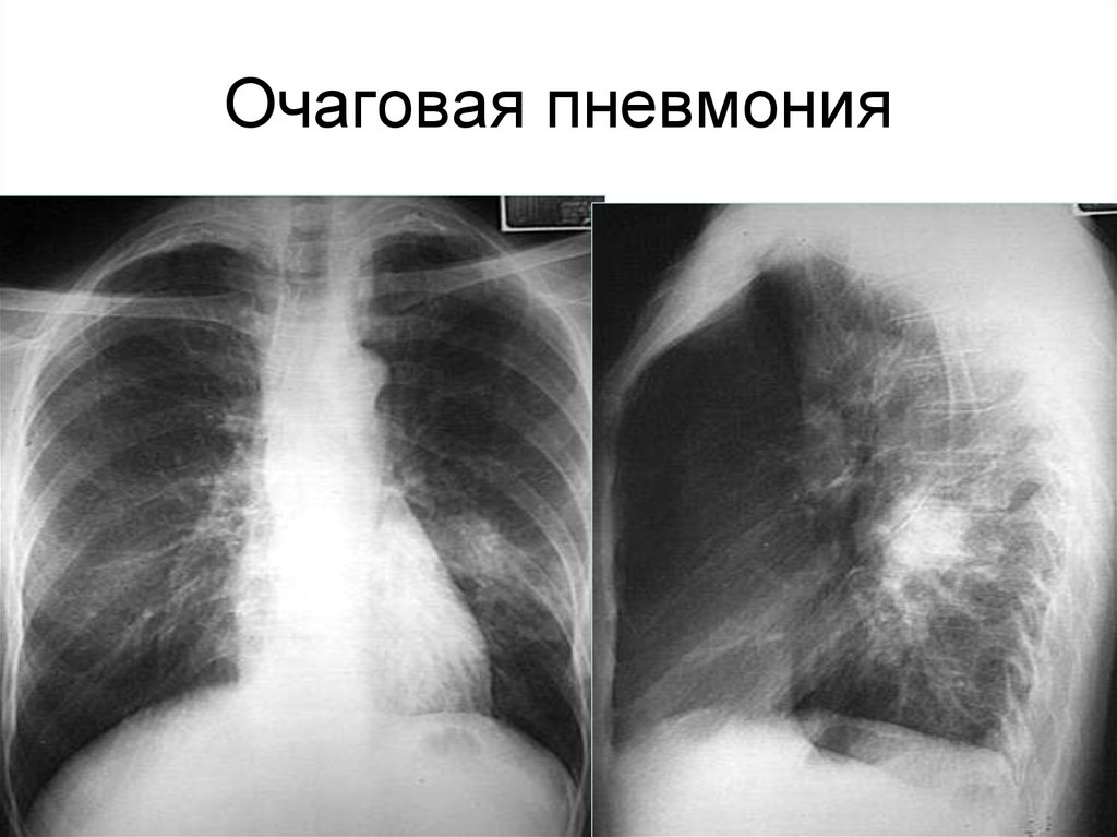 Рентген картина пневмонии