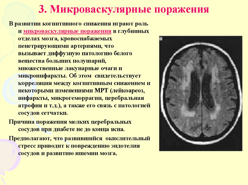 Атрофия головного мозга степени. Хроническая ишемия головного мозга мрт. Лакунарный ишемический инсульт головного мозга мрт. Очаги лейкоареоза в головном мозге что это. Лейкоареоз головного мозга мрт.