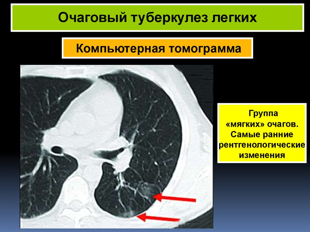 Фото кт легких при туберкулезе