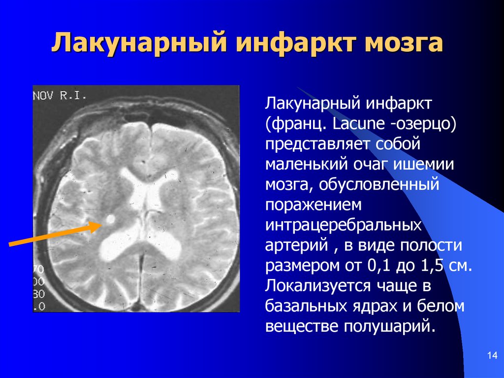 Сосудистый очаг в головном мозге что это. Лакунарный ишемический инсульт кт. Лакунарный инфаркт головного мозга кт. Лакунарный инсульт на мрт головного мозга. Лакунарный инфаркт головного мозга мрт.
