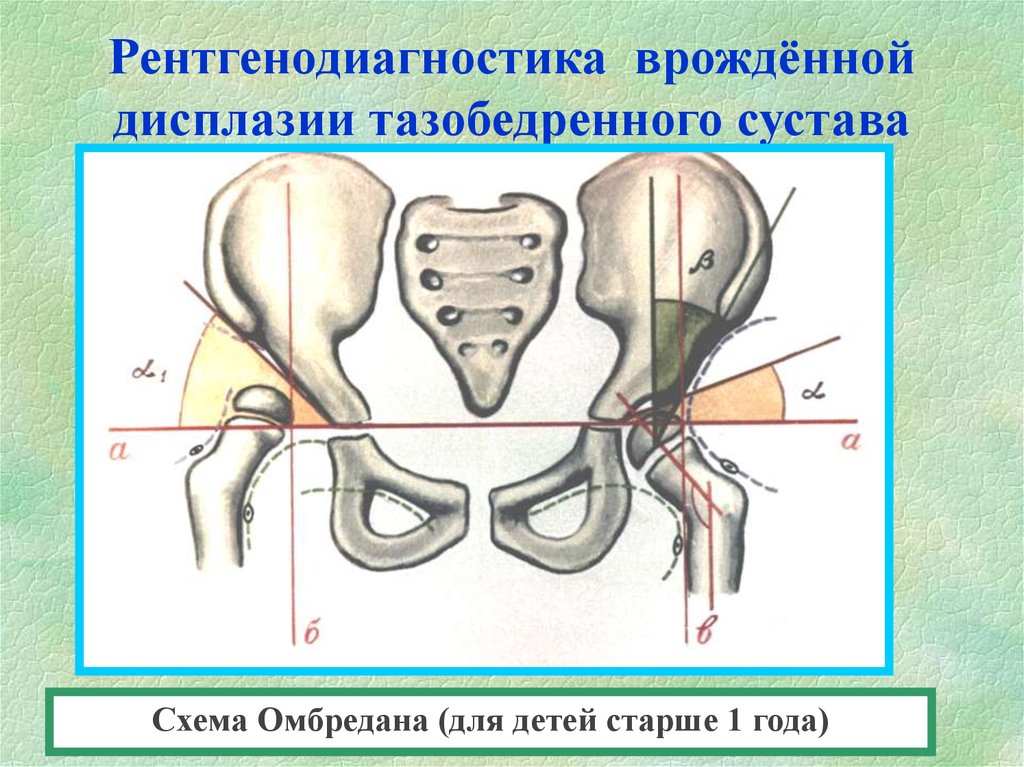 Схема хильгенрейнера тазобедренных суставов у детей