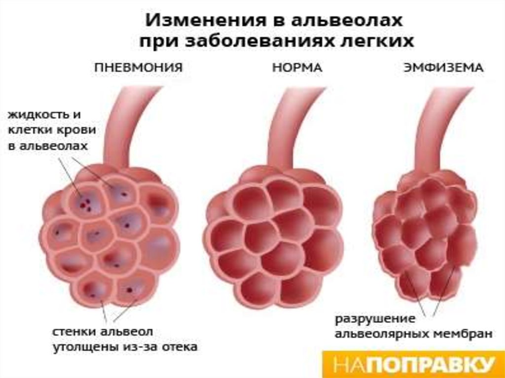 Эмфизема легких что это. Альвеолярная буллёзная эмфизема.