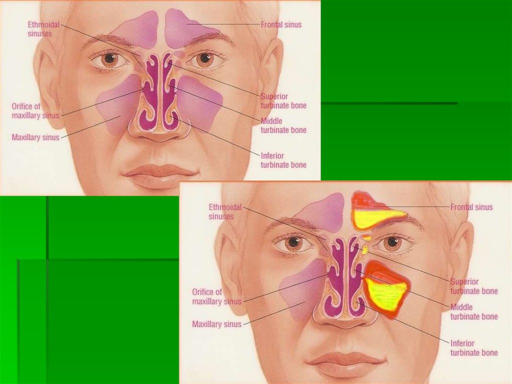 Заболевания придаточных пазух носа. Пазухи носа анатомия гайморит. Строение носа и пазух анатомия. Строение носовой полости гайморовой пазухи. Строение носа и гайморовых пазух.