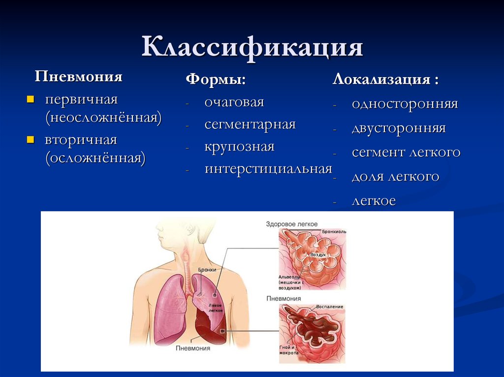 Пневмония очаговая презентация