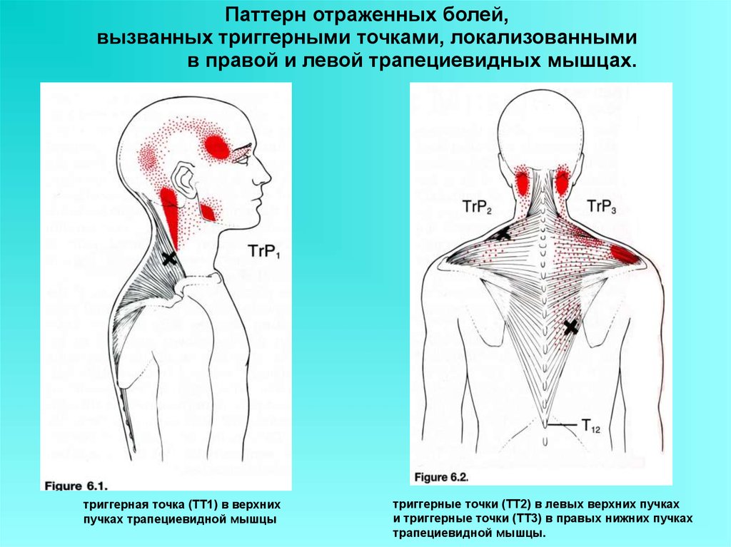 Локализация боли в спине на картинках