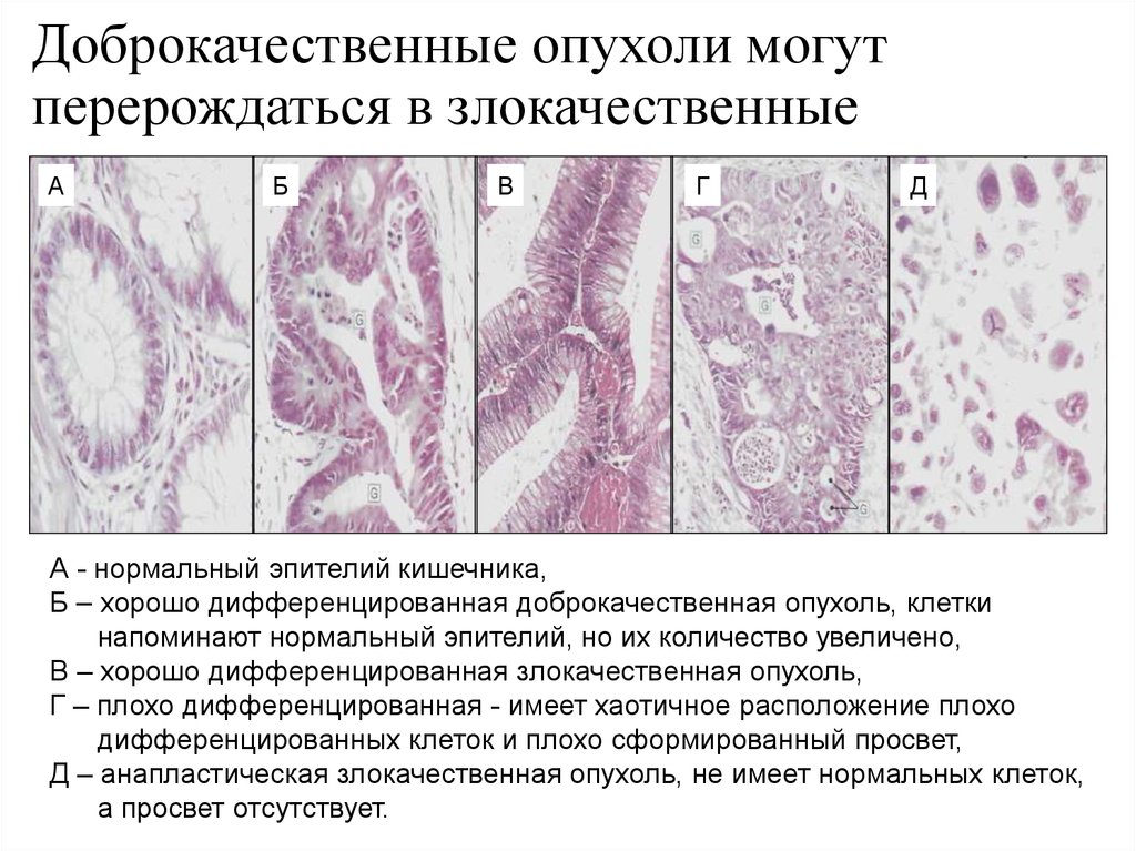 Картинки злокачественные и доброкачественные опухоли