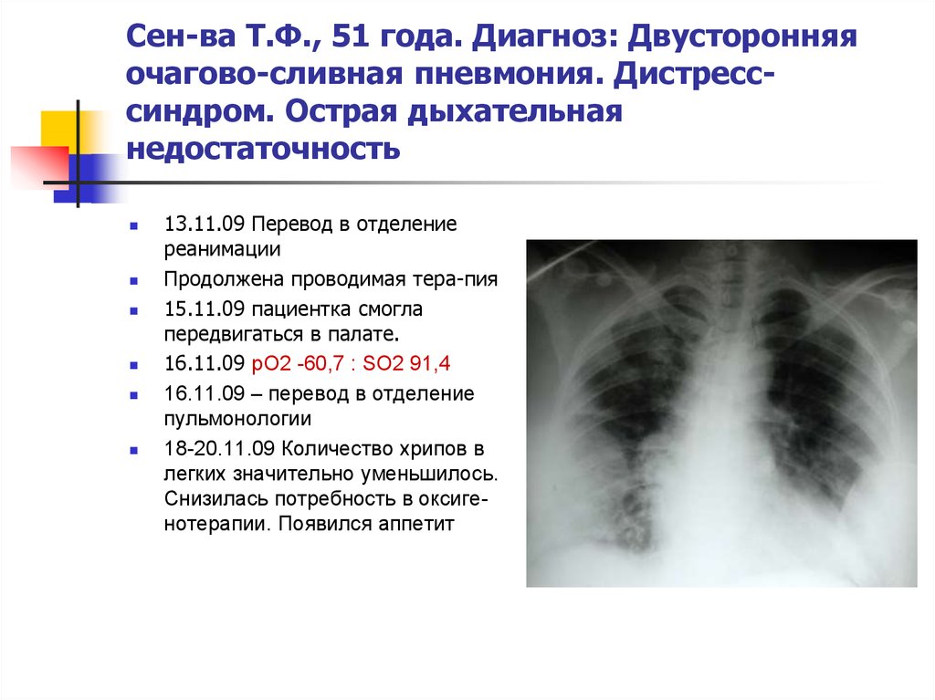 Двусторонняя пневмония это. Очагово сливная пневмония рентген. Полисегментарная очаговая пневмония. Двухсторонний очагово сливной полисегментарная пневмония. Сливная дольковая пневмония.