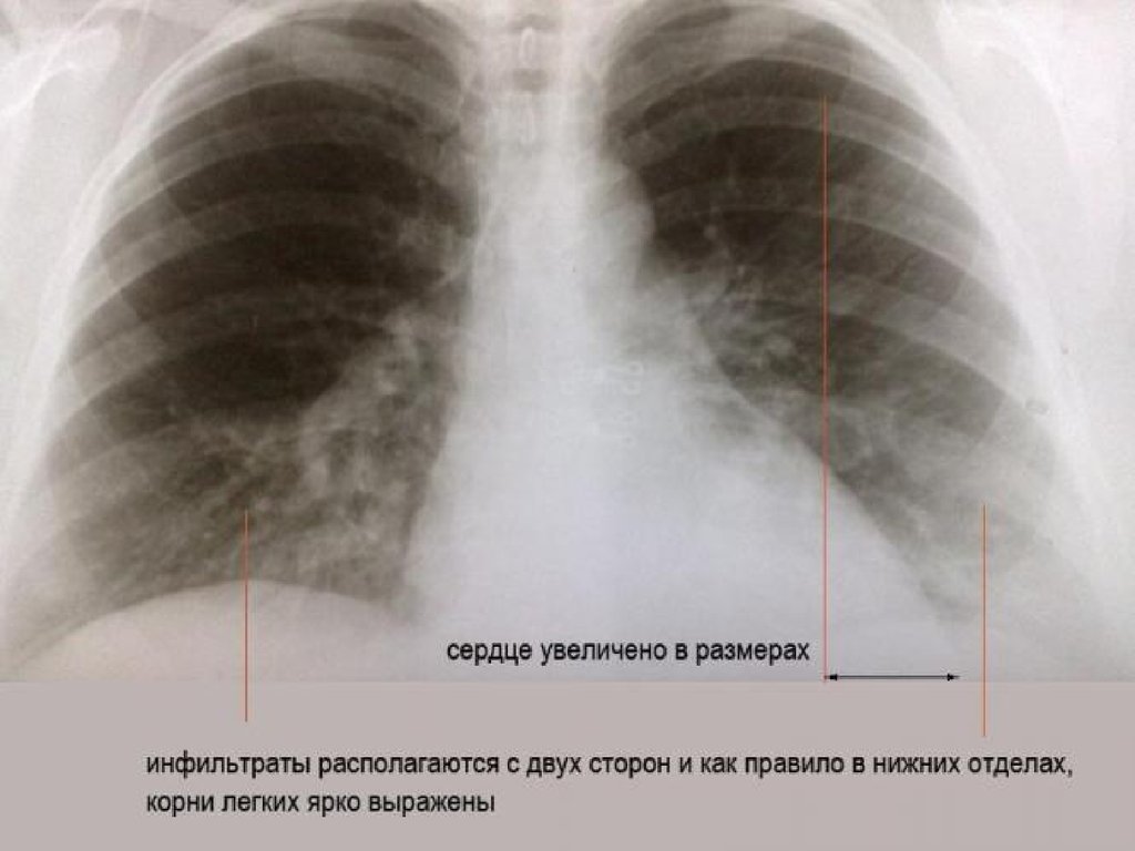 Рентгенологическая картина пневмонии у детей