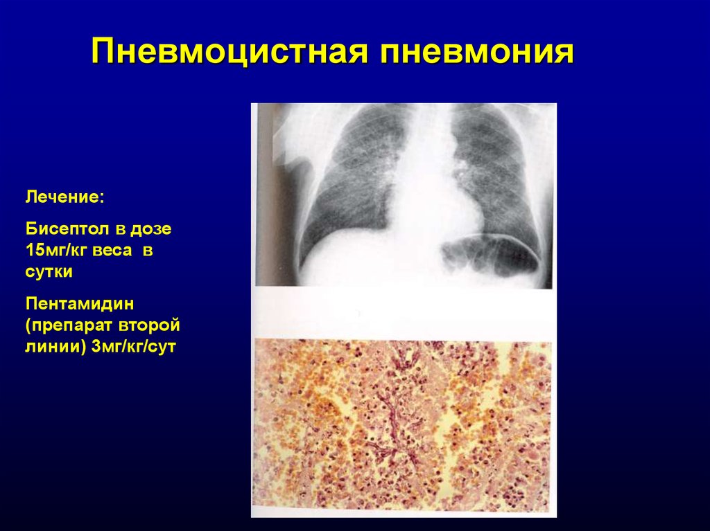 Схема лечения пневмоцистной пневмонии