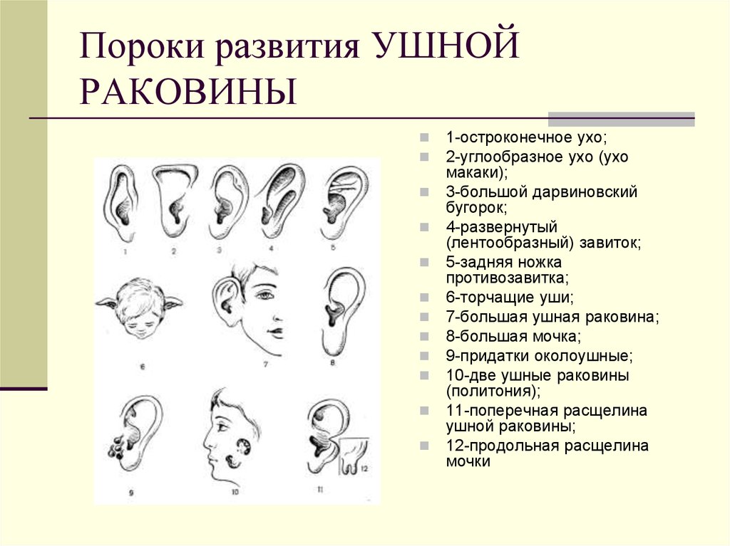 Аномалии развития уха презентация