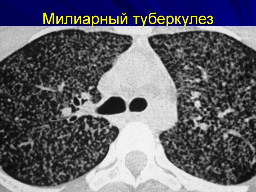 Мелкие очаги в легких на кт. Лимфогенный диссеминированный туберкулез легких на кт. Милиарный туберкулез кт. Лимфогенный туберкулез на кт. Лимфогенно диссеминированный туберкулез кт.