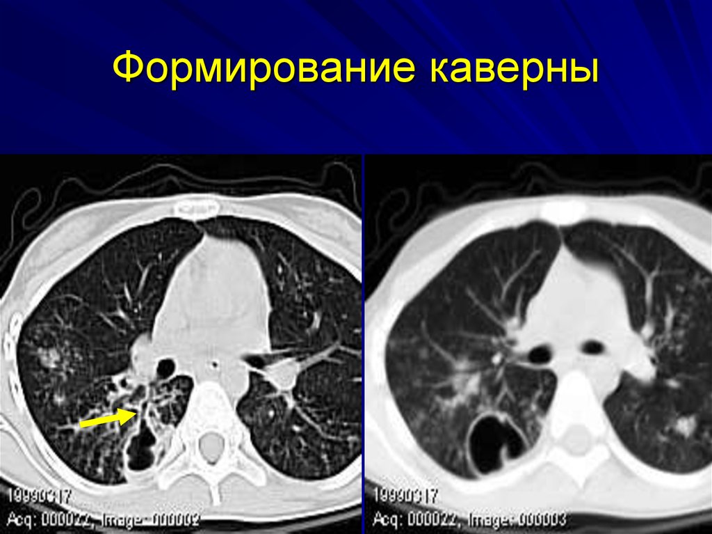 Очаговые изменения в легких на кт. Диссеминированный кавернозный туберкулез кт. Милиарный туберкулез кт картина. Кавернозный туберкулез кт. Туберкулез с кавернами на кт легких.