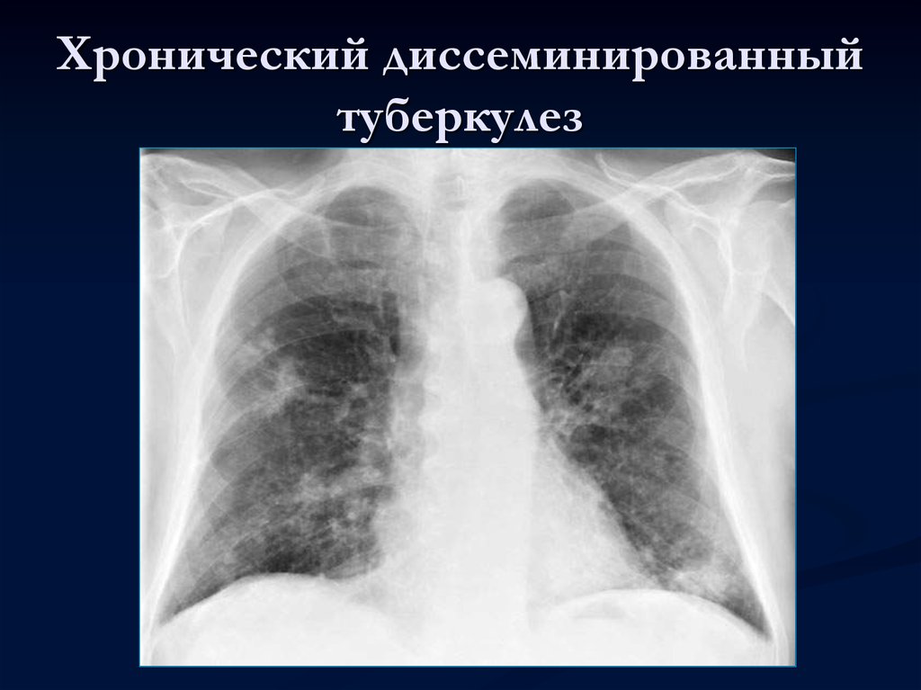 Формы диссеминированного туберкулеза. Хронический диссеминированный туберкулез рентген. Хронический гематогенно диссеминированный туберкулез. Хронический милиарный туберкулез. Гематогенно диссеминированный туберкулез рентген.