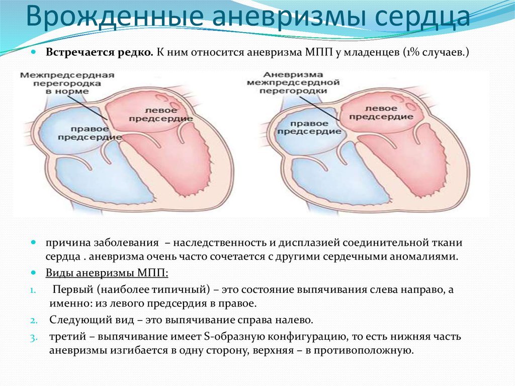 Аневризма перегородки у ребенка. Аневризма МПП сердца у ребенка. Аневризма МПП сердца типы. Межпредсердная перегородка в средней трети истончена.