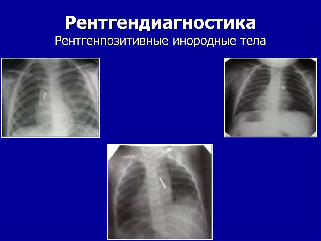 Инородные тела дыхательных путей причины. Инородные тела в бронхах у детей рентгенодиагностика. Рентгенодиагностика инородных тел. Инородное тело в дыхательных путях у ребенка. Инородное тело в дыхательных путях рентген.