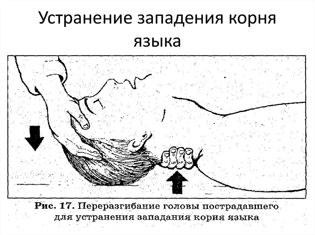 На рисунке 69 показано что происходит при западении языка