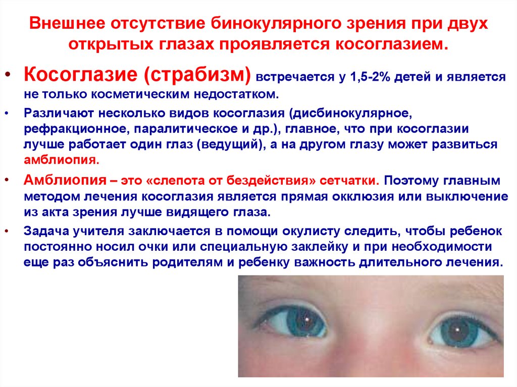 Косоглазие симптомы. Отсутствие бинокулярного зрения. Причины развития косоглазия. Косоглазие у детей причины. Недостатки бинокулярного зрения.