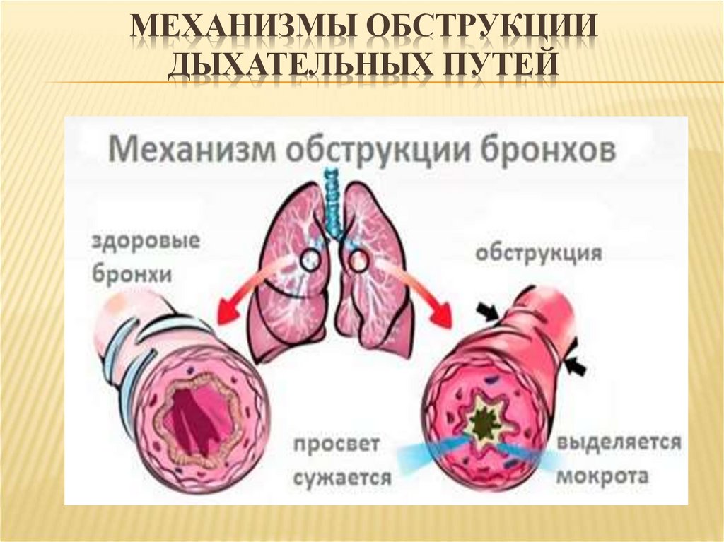 Признаки обструкции дыхательных путей схема полная и частичная может дышать