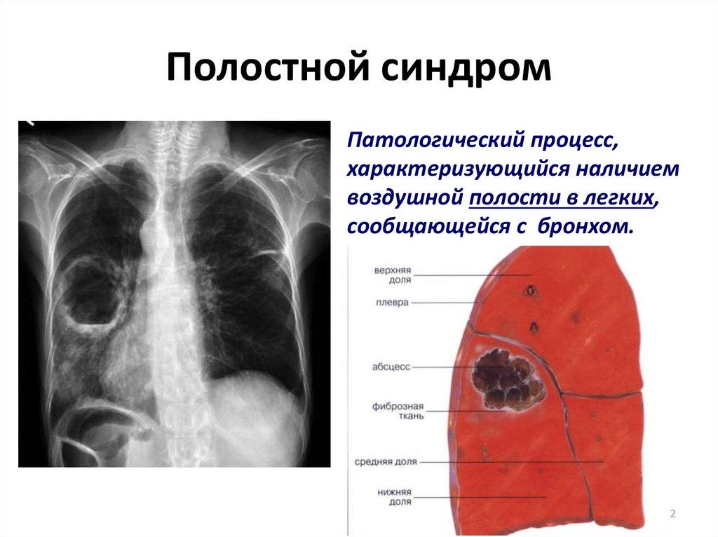 Абсцесс легкого картинки