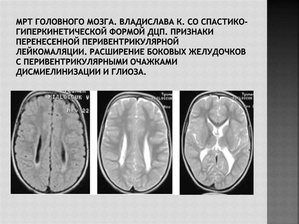 Расширение желудочков дети. Мрт головного мозга при ДЦП. Кт мозга при ДЦП. Кт головного мозга при ДЦП. Изменения при ДЦП на кт головного мозга.