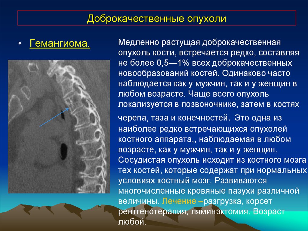 Рак костного мозга симптомы. Доброкачественная опухоль. Недоброкачественная опухоль что. Доброкачественные опухоли костей. Доброкачественные костные опухоли.