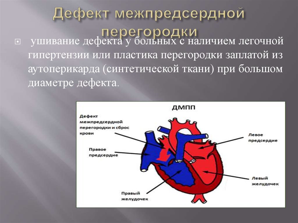 Дефект межпредсердной. Ушивание межпредсердной перегородки. Вторичный Центральный дефект межпредсердной перегородки 14мм. Схема операции дефект межпредсердной перегородки. Первичный ДМПП.