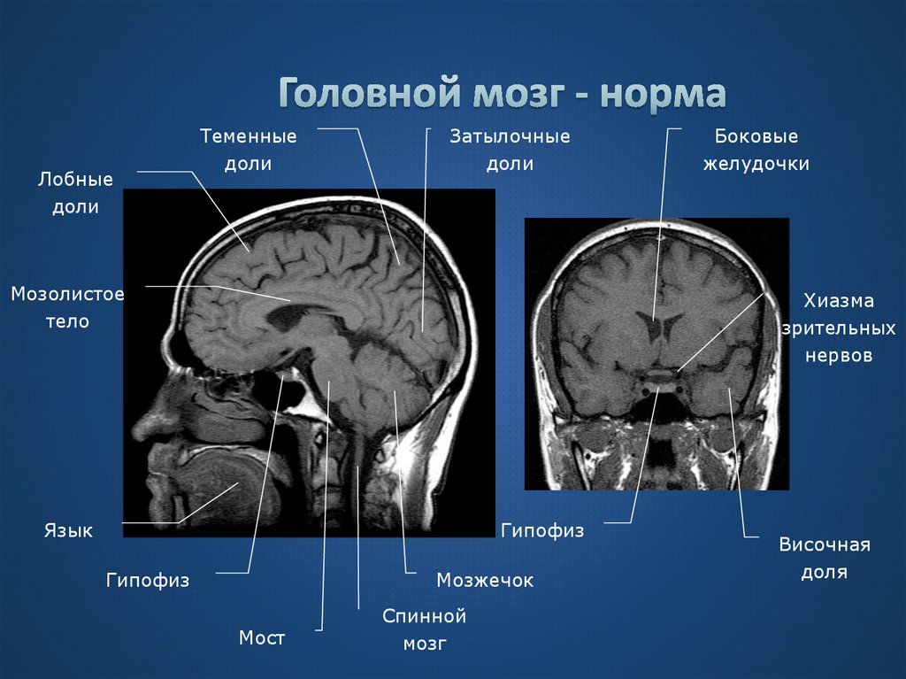 Кт головы москва. Мрт норма анатомия головного мозга. Мозолистое тело анатомия мрт. Мрт головного мозга сагиттальная проекция. Мрт мозга Сагиттальный срез.