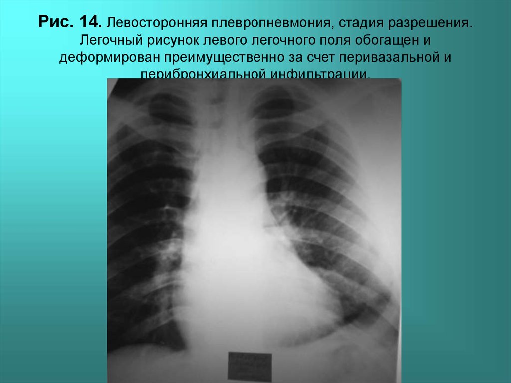 Плевропневмония. Сгущение легочного рисунка. Признаки разрешения пневмонии. Легочный рисунок. Легочный рисунок деформирован.