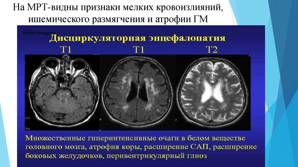 Атрофия мозга симптомы. Атрофия головного мозга на кт. Атрофические изменения головного мозга кт. Атрофия коры головного мозга мрт.