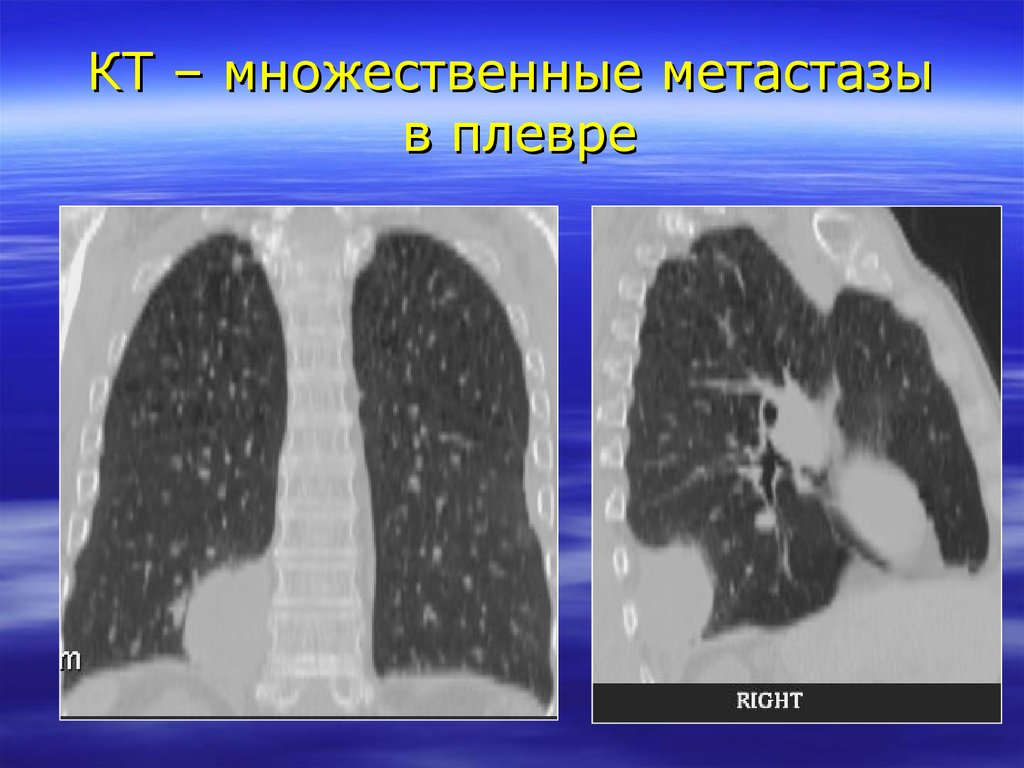 Пошли метастазы в легкие. Опухоли плевры рентген.