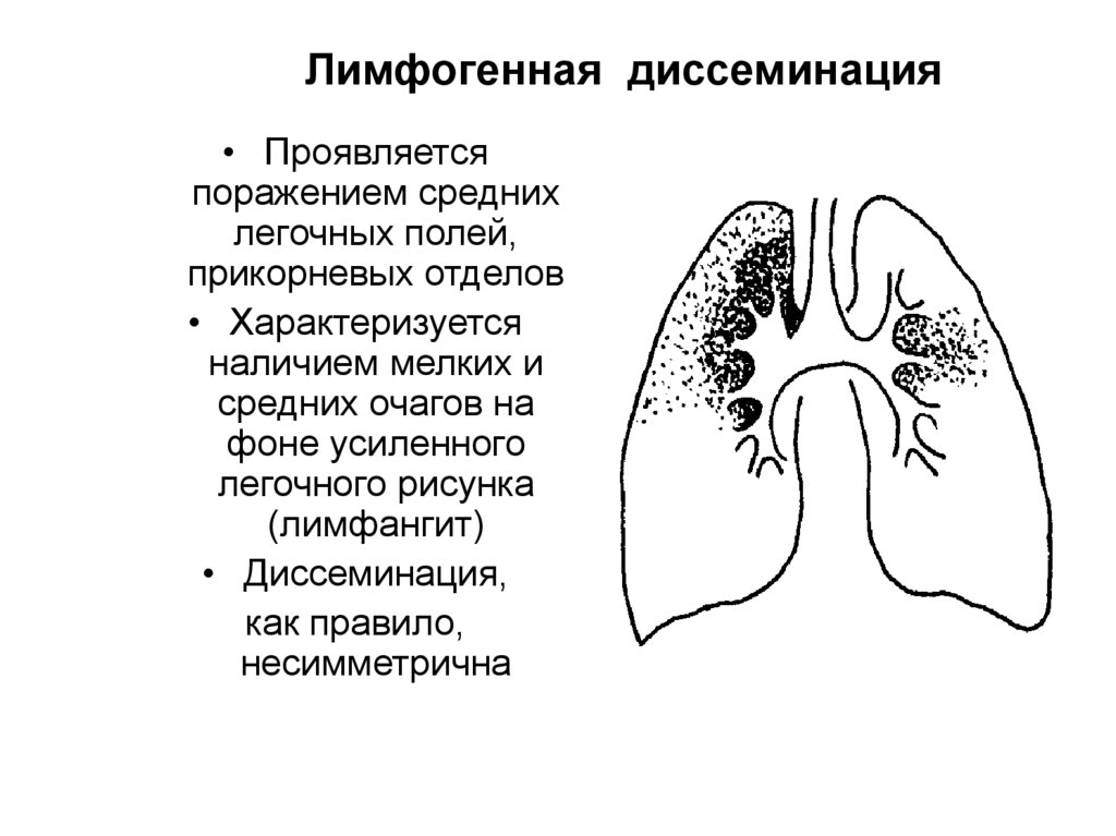 Лимфогенный туберкулез. Лимфогенно диссеминированный туберкулез рентген. Лимфогенный диссеминированный туберкулез. Лимфогенная бронхогенная диссеминация. Лимфогенный диссеминированный туберкулез легких это.