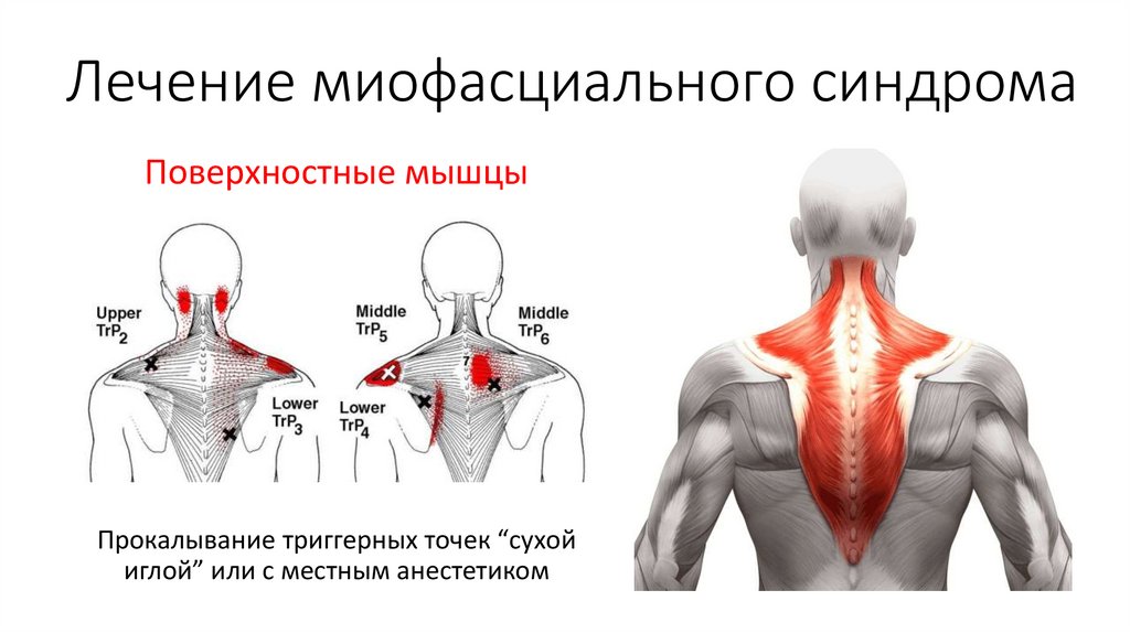 Болит мышца спины справа. Триггерная точка миофасциальный болевой. Миофасциальный болевой Синд. Миофасциальные триггерные точки спины. Триггерная зона,миофасциальный синдром.