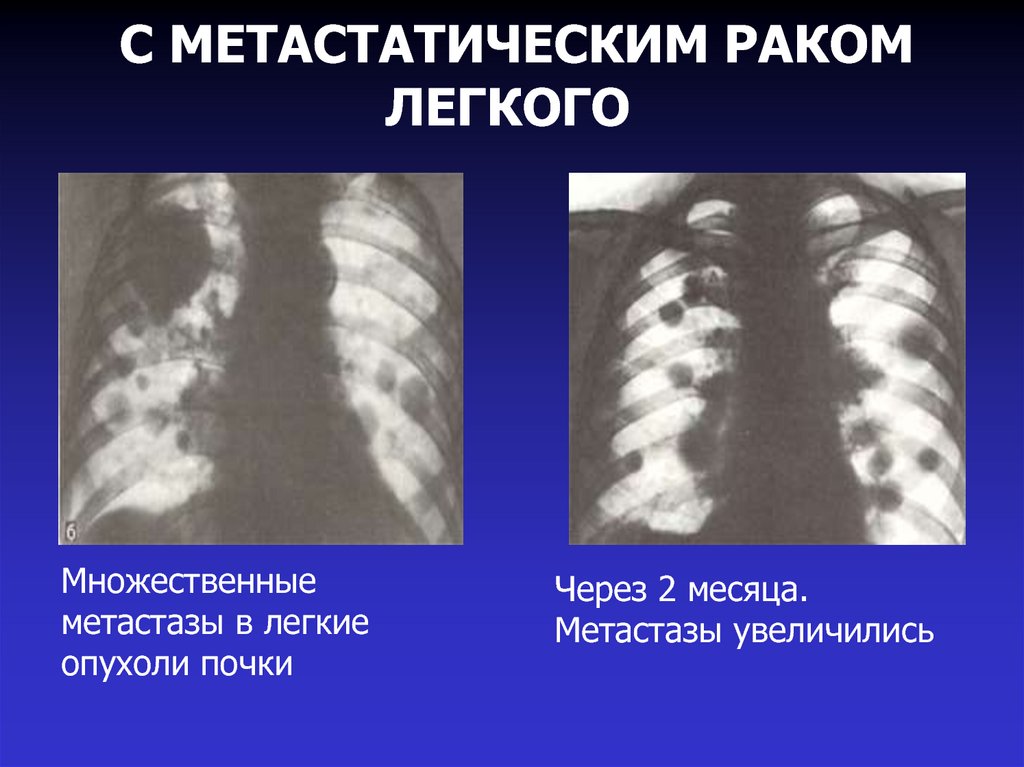 Отдаленные метастазы при раке. Метастазы в лёгких рентген заключение. Метастатические опухоли легких. Метастатическое поражение легких.