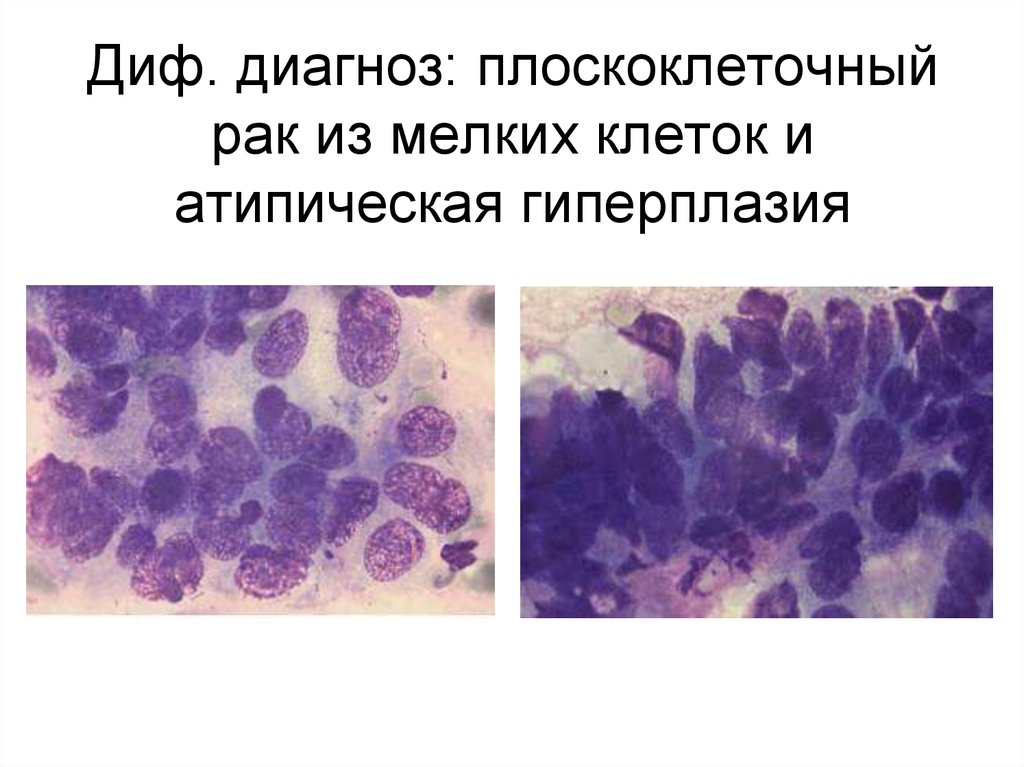 Диагноз желез гиперплазия. Цитологическая картина плоскоклеточной карциномы. Резервноклеточная гиперплазия. Клеточная гиперплазия.